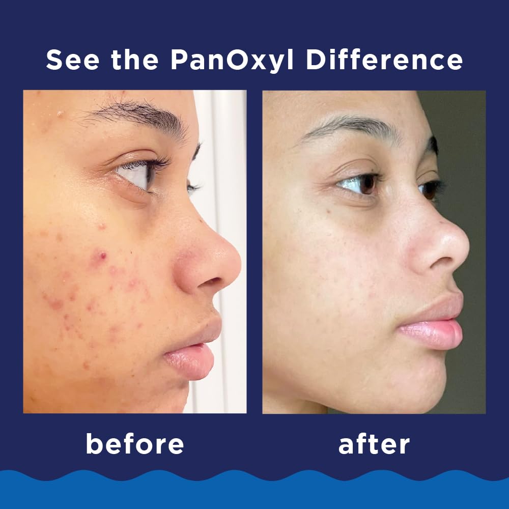 PanOxyl Acne Foaming Wash | 10% Benzoyl Peroxide Maximum Strength | Face & Body Cleanser, 5.5 oz