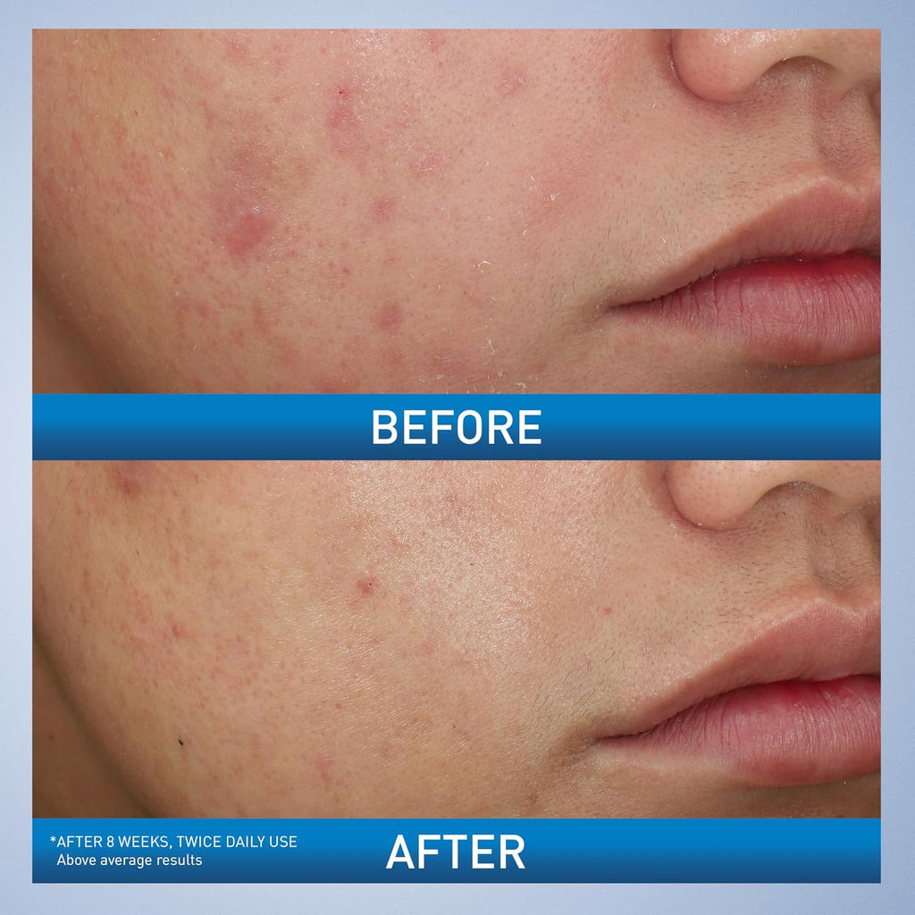 CeraVe Acne Foaming Cream Wash | 10% Benzoyl Peroxide Face & Body Cleanser | Fragrance Free, 5oz