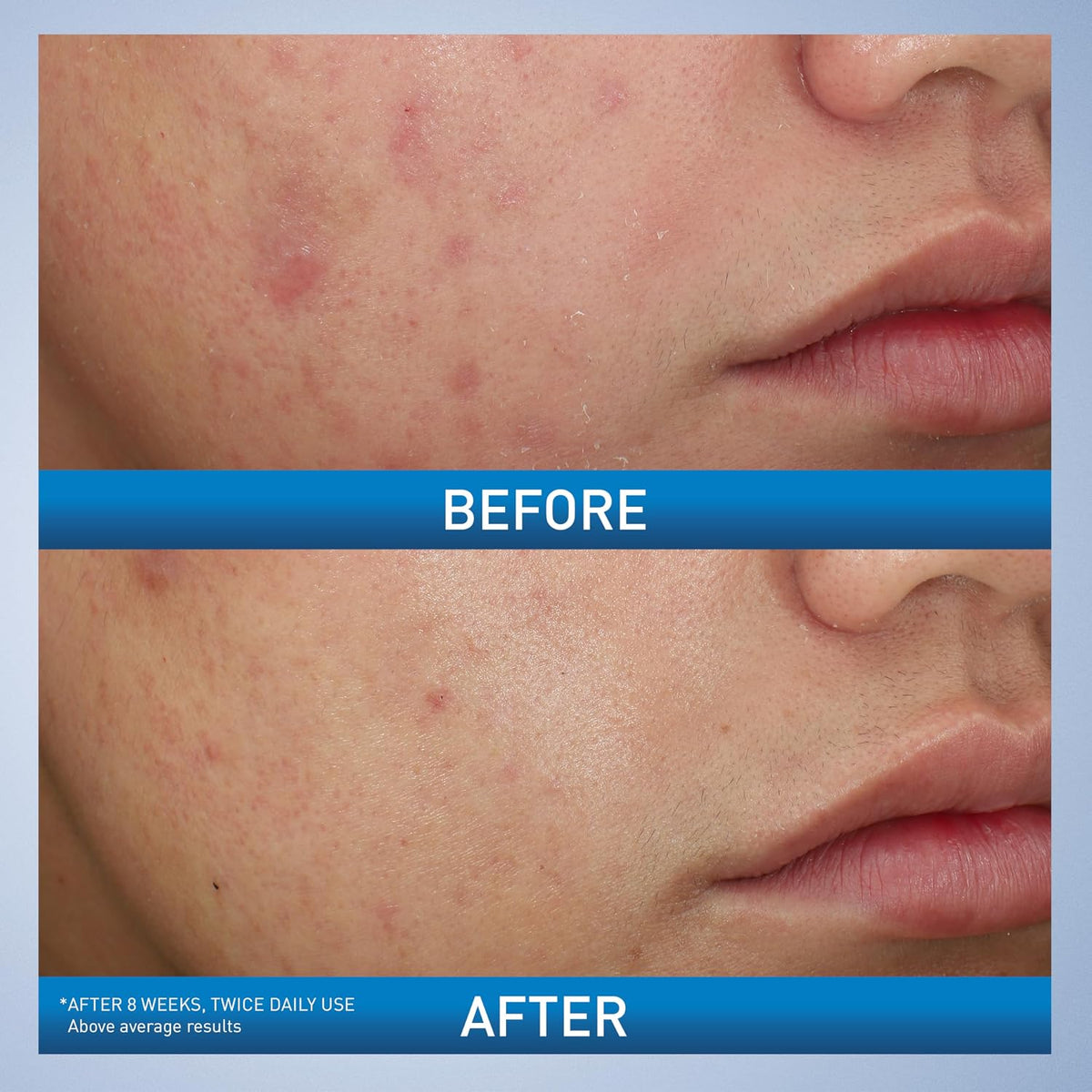 CeraVe Acne Foaming Cream Wash | 10% Benzoyl Peroxide Face & Body Cleanser | Fragrance Free, 5oz