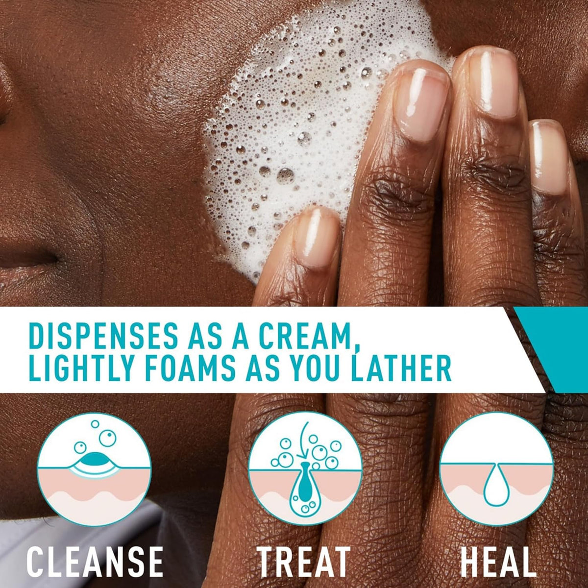 CeraVe Acne Foaming Cream Cleanser | 4% Benzoyl Peroxide Face Wash | Fragrance Free, 5oz